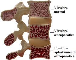 fractura_vertebral
